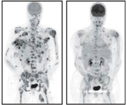 PET scan showing decrease in melanoma tumors using drug developed in part at SLAC