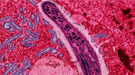 malaria-thumb.jpg